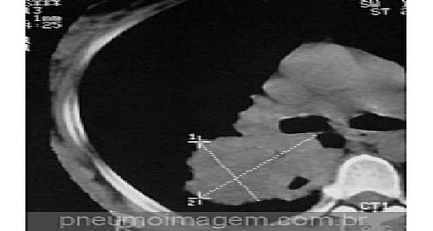 CORTISOL S�RICO PREV� MORTE EM PNEUMONIA INDEPENDENTE DO ESCORE CURB-65